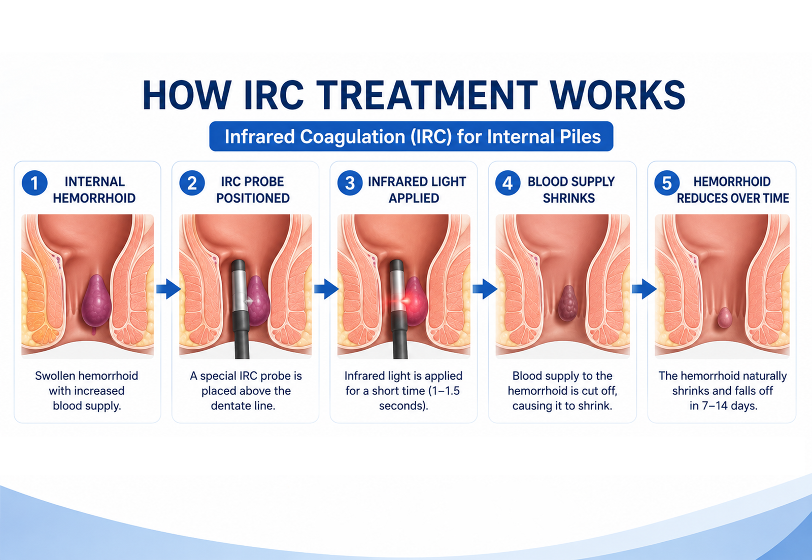 IRC Infrared Coagulation treatment for piles - step by step procedure explanation.